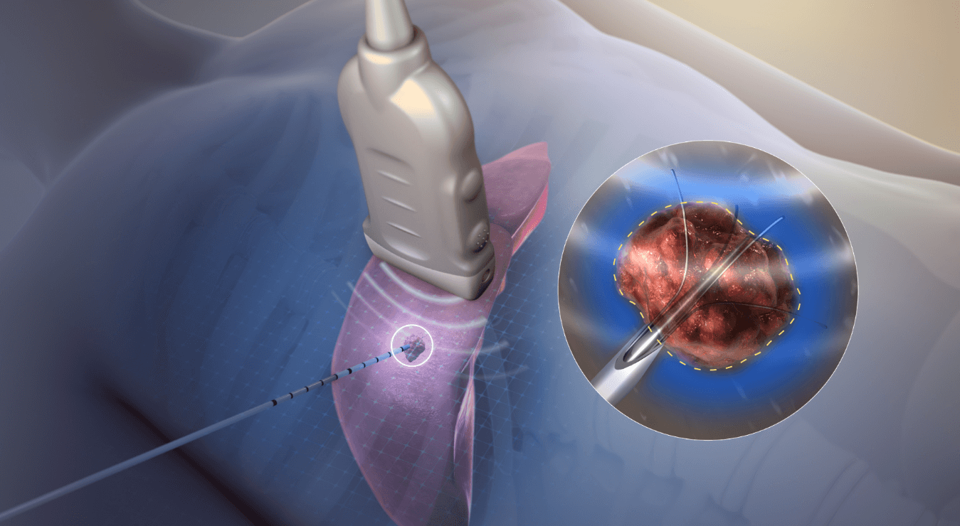 Radiofrequency Ablation for Arrhythmia: How It Works & Who Needs