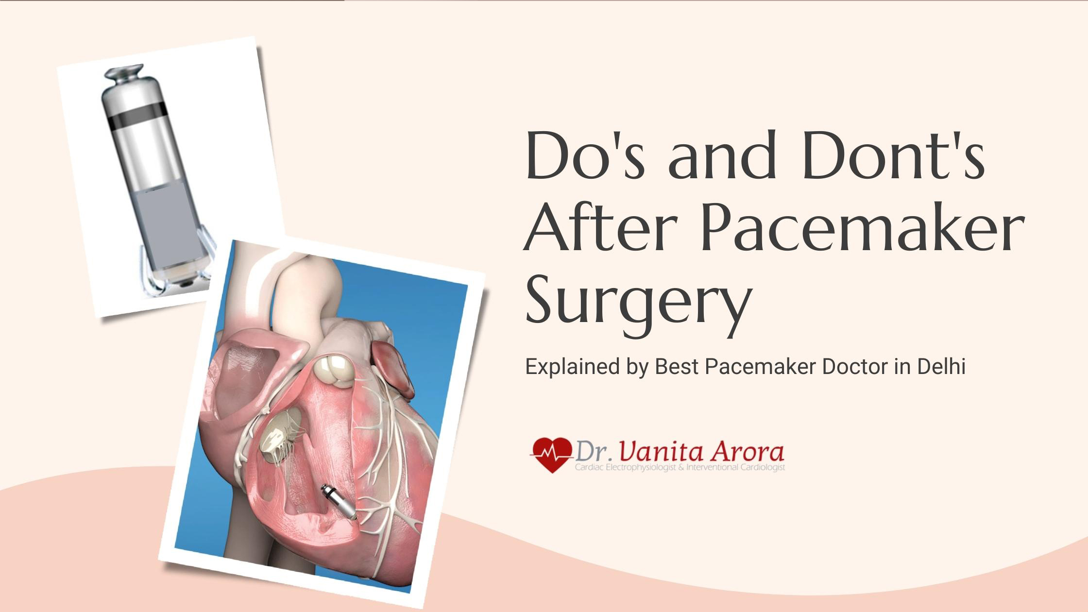 Best Pacemaker Doctor in Delhi Lists the Do's and Don'ts After Pacemaker Surgery