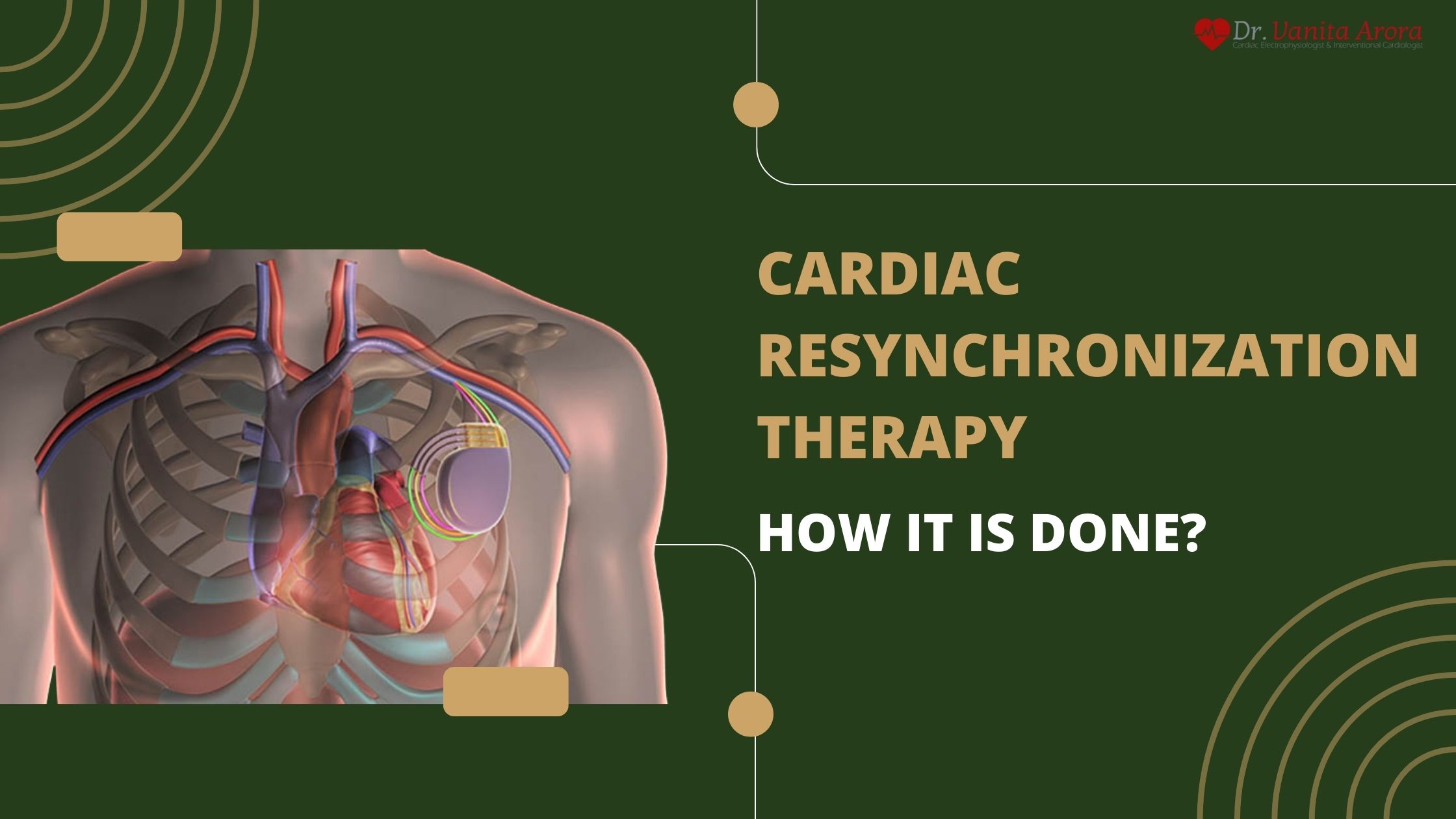 Cardiac Resynchronization Therapy: How It is Done?