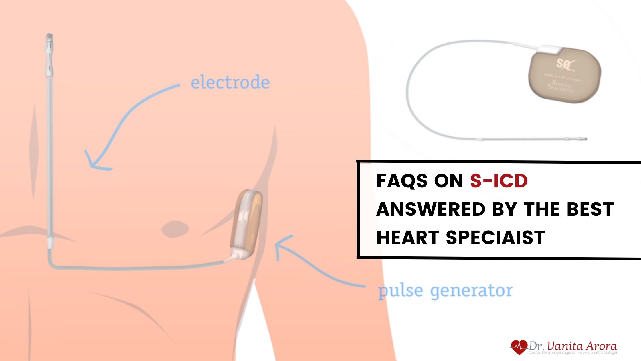 FAQs on S-ICD by Best Heart Specialist in Delhi