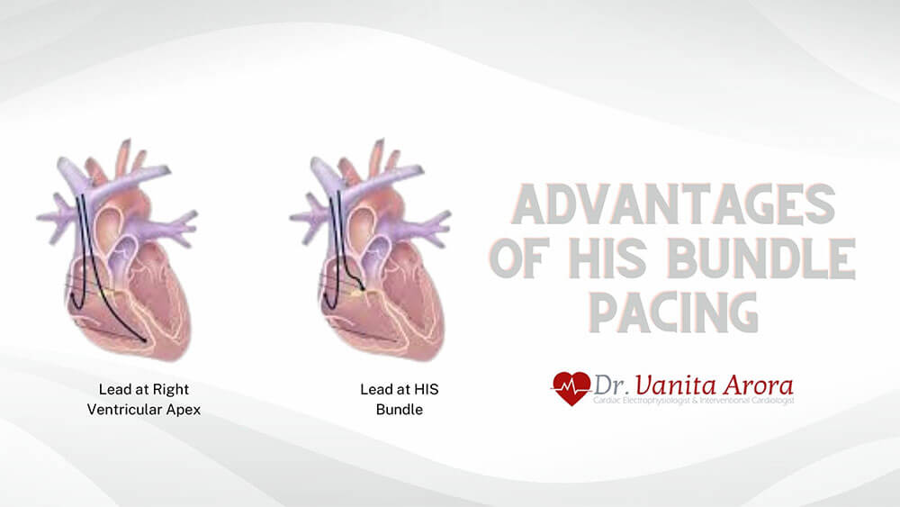 HIS Bundle Pacing by best cardiologist in Delhi NCR