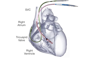 Ventricular arrhythmia treatment