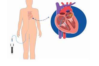 Radiofrequency ablation heart