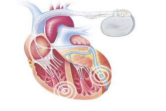 Cardiac resynchronization therapy